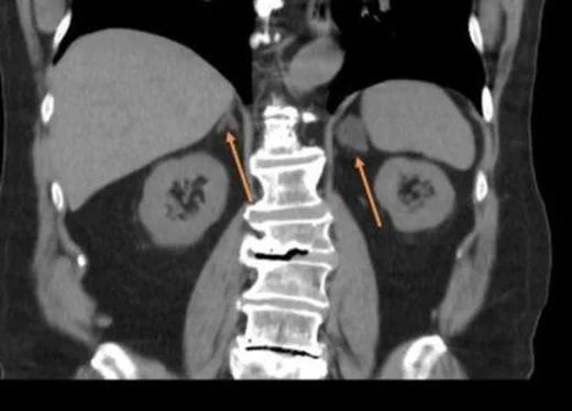 Adrenal hiperplazi: yayımlanmış olgu görüntüsü, aksiyel kesit