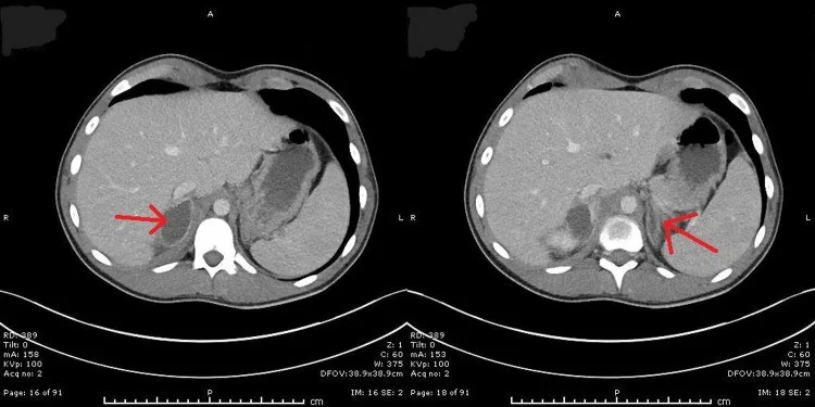 Adrenal enfeksiyon ve granülomatöz tutulum: yayımlanmış olgu görüntüsü, aksiyel kesit