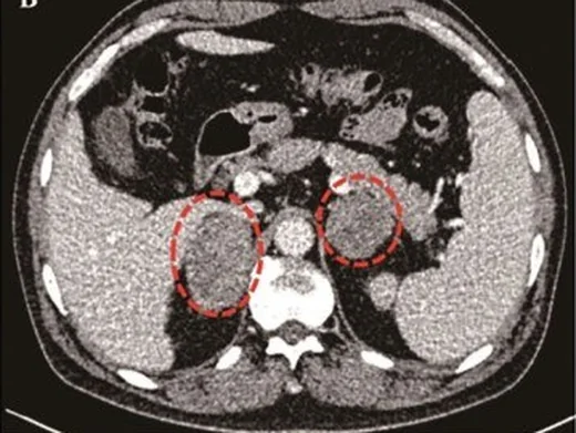 Adrenal lenfoma: yayımlanmış olgu görüntüsü, aksiyel kesit