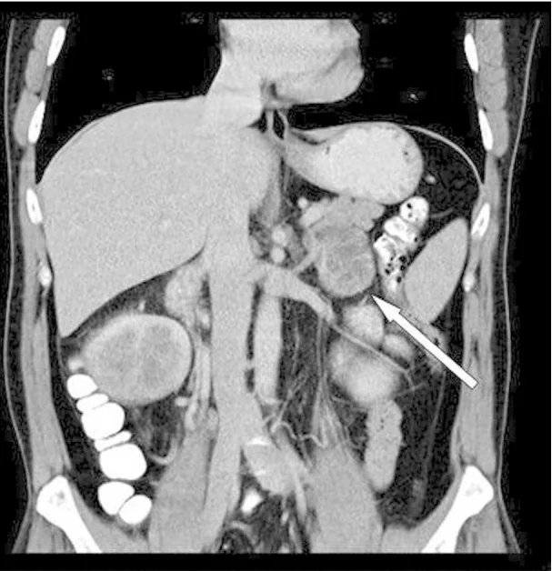 Adrenal metastaz: yayımlanmış olgu görüntüsü, koronal kesit