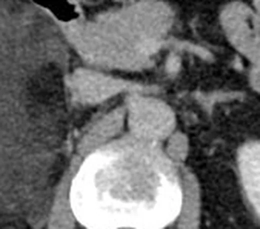 Adrenal miyelolipom: yayımlanmış olgu görüntüsü, aksiyel kesit
