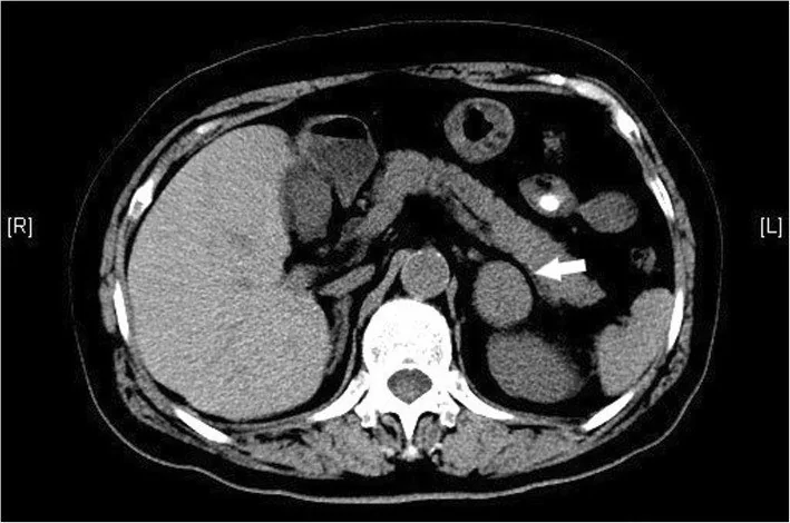 Adrenal nöroblastom: yayımlanmış olgu görüntüsü, aksiyel kesit