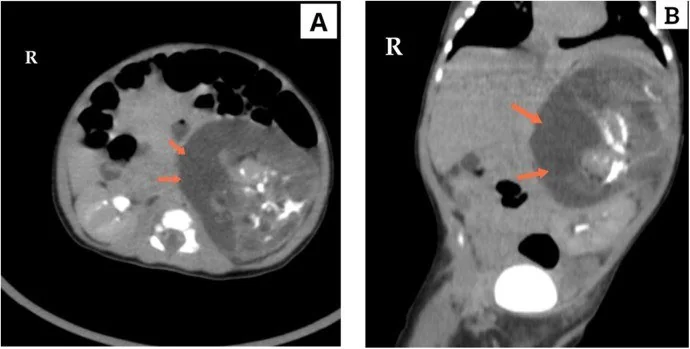 Adrenal teratom ve diğer nadir yağlı adrenal kitleler: yayımlanmış olgu görüntüsü, aksiyel kesit