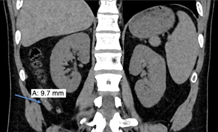 Appendiks nöroendokrin tümörü: yayımlanmış olgu görüntüsü, koronal kesit