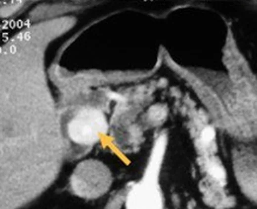 Duodenal nöroendokrin tümör (gastrinoma dahil): yayımlanmış olgu görüntüsü, 3B kesit