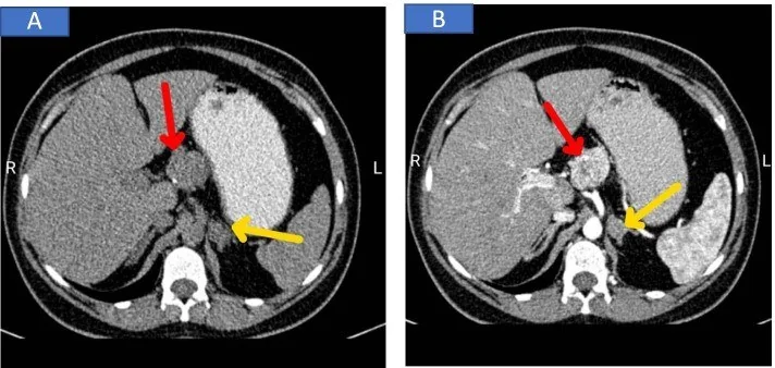 MEN tip 1: hipofiz–duodenum/pankreas–adrenal örüntüsü: yayımlanmış olgu görüntüsü, aksiyel kesit