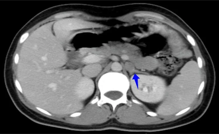 MEN tip 2: feokromositoma örüntüsü: yayımlanmış olgu görüntüsü, aksiyel kesit