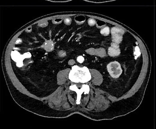 Nöroendokrin tümör peritoneal ve nodal yayılımı: yayımlanmış olgu görüntüsü, aksiyel ve koronal kesit