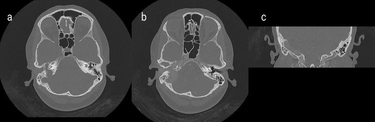 Jugulotimpanik paraganglioma: yayımlanmış olgu görüntüsü, aksiyel kesit