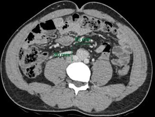 Organ of Zuckerkandl ve pelvik paraganglioma: yayımlanmış olgu görüntüsü, 3B kesit