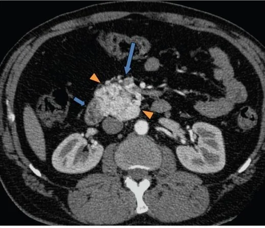 Retroperitoneal paraganglioma: yayımlanmış olgu görüntüsü, aksiyel kesit