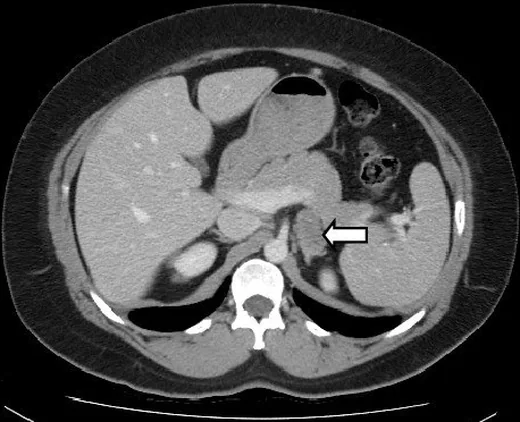 Periadrenal damar, lenf nodu ve retroperitoneal taklitçiler: yayımlanmış olgu görüntüsü, aksiyel kesit