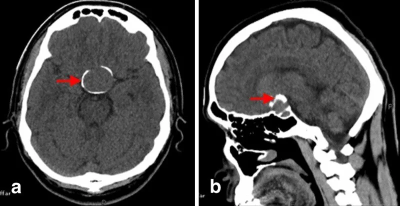 Sellar kalsifikasyon ve normal kemik taklitçileri: yayımlanmış olgu görüntüsü, aksiyel ve sagittal kesit
