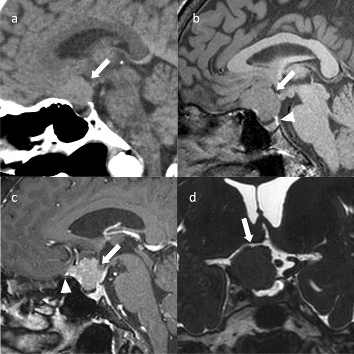 Sellar/parasellar meningiom: yayımlanmış olgu görüntüsü, sagittal kesit