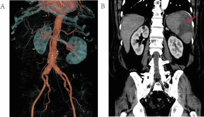 Splenomegali: yayımlanmış olgu görüntüsü, 3B + koronal kesit