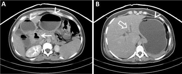 Duodenal divertikül ve komplike divertikülit: yayımlanmış olgu görüntüsü, aksiyel kesit