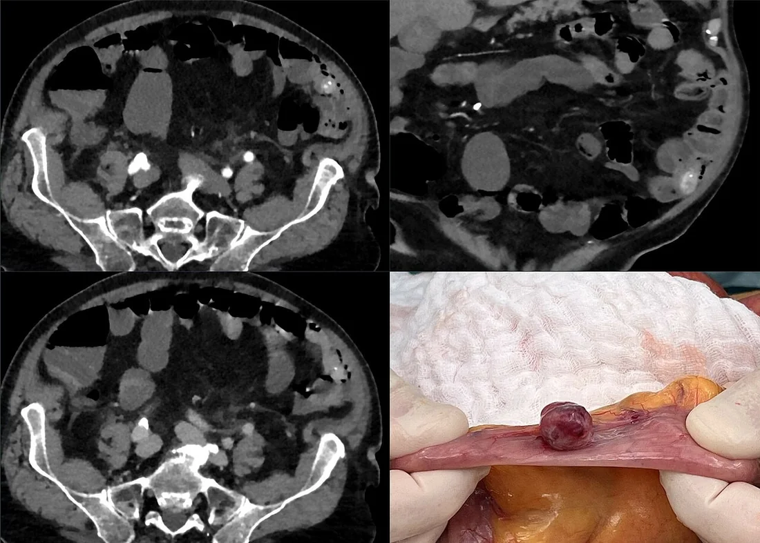 İnce barsak gastrointestinal stromal tümörü: yayımlanmış olgu görüntüsü, aksiyel kesit