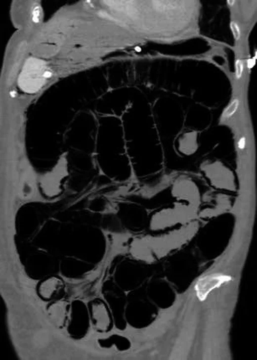 İskemik ince barsak hasarı ve infarkt: yayımlanmış olgu görüntüsü, koronal kesit