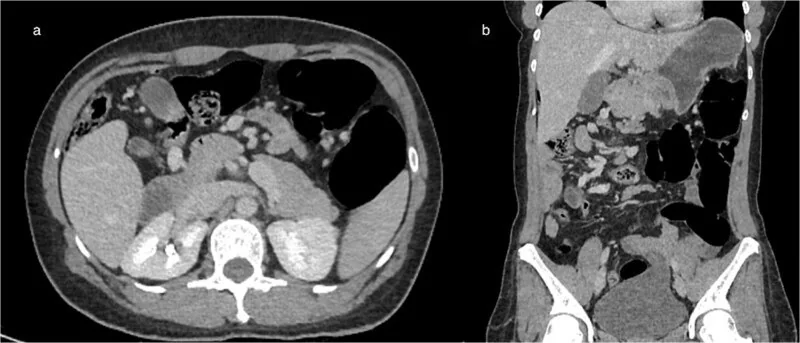 İntestinal malrotasyon ve orta barsak volvulusu: yayımlanmış olgu görüntüsü, aksiyel kesit