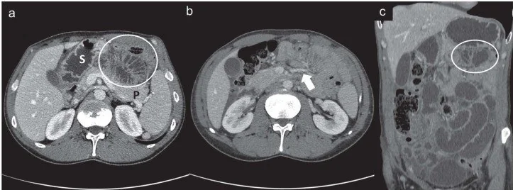 Paraduodenal herni: yayımlanmış olgu görüntüsü, koronal kesit