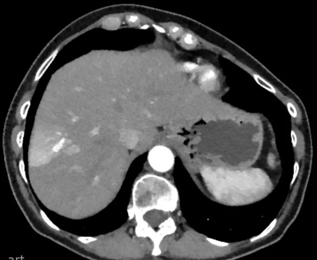 Arterioportal şant ve geçici hepatik atenüasyon farkı (THAD): yayımlanmış olgu görüntüsü, aksiyel kesit