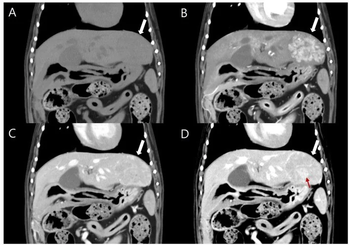 İnflamatuvar hepatoselüler adenom: yayımlanmış olgu görüntüsü, koronal kesit