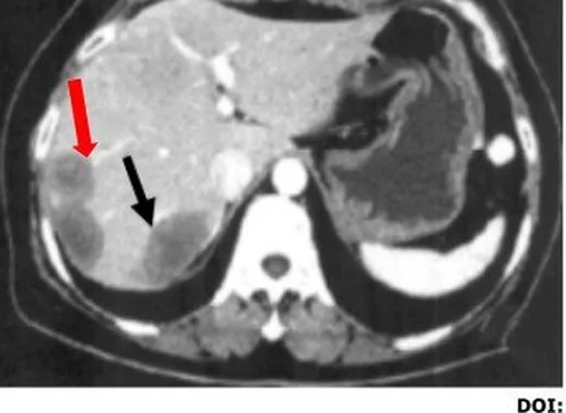 Hepatik epiteloid hemanjiyoendotelyoma: yayımlanmış olgu görüntüsü, aksiyel kesit