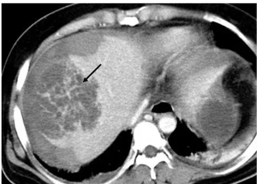 Peliosis hepatis: yayımlanmış olgu görüntüsü, aksiyel kesit