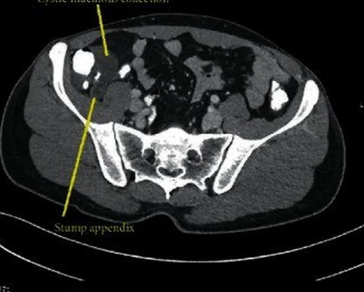 Apendiks mukoseli ve müsinöz neoplazi: yayımlanmış olgu görüntüsü, sagittal kesit