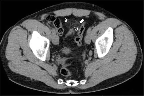 Epiploik appendajit: yayımlanmış olgu görüntüsü, aksiyel kesit