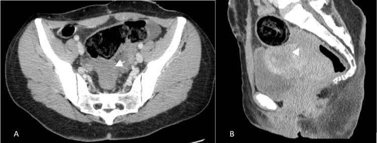 Rektosigmoid endometriozis (BT taklitçisi): yayımlanmış olgu görüntüsü, aksiyel+sagittal kesit