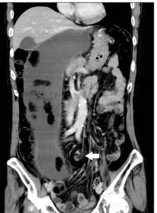 Sigmoid volvulus: yayımlanmış olgu görüntüsü, koronal kesit