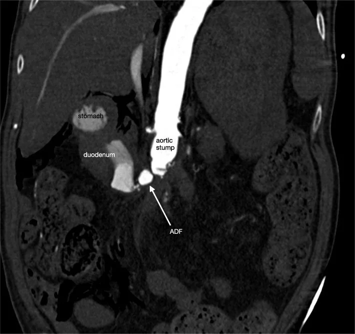 Aortoduodenal fistül: yayımlanmış olgu görüntüsü, koronal kesit