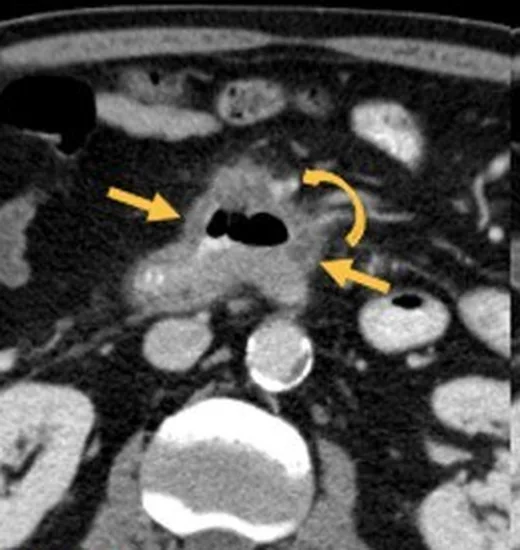 Duodenal adenokarsinom: yayımlanmış olgu görüntüsü, aksiyel kesit
