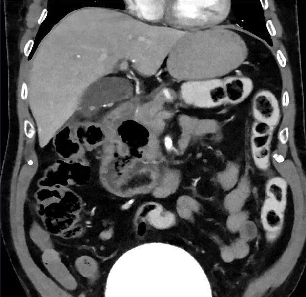 Duodenal divertikül: yayımlanmış olgu görüntüsü, aksiyel ve koronal kesit