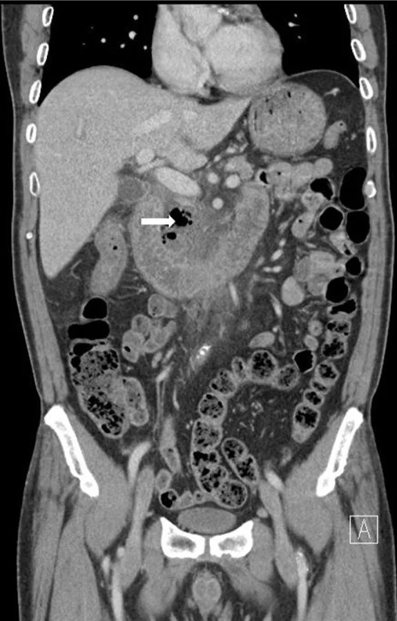 Duodenal divertikülit ve perforasyon: yayımlanmış olgu görüntüsü, koronal kesit