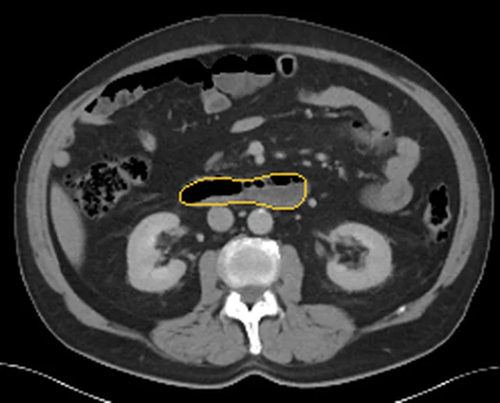 Bölge anatomisi, BT kesiti: Duodenum sınırı sarı çizgiyle işaretli