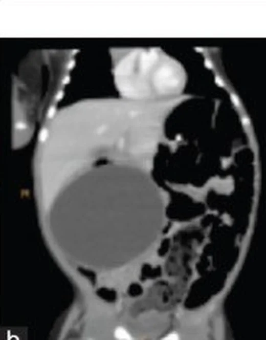 Duodenal duplikasyon kisti: yayımlanmış olgu görüntüsü, çoklu düzlem kesit