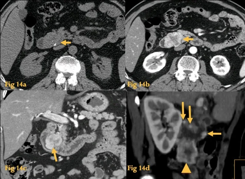 Duodenal GİST ve diğer subepitelyal tümörler: yayımlanmış olgu görüntüsü, aksiyel kesit