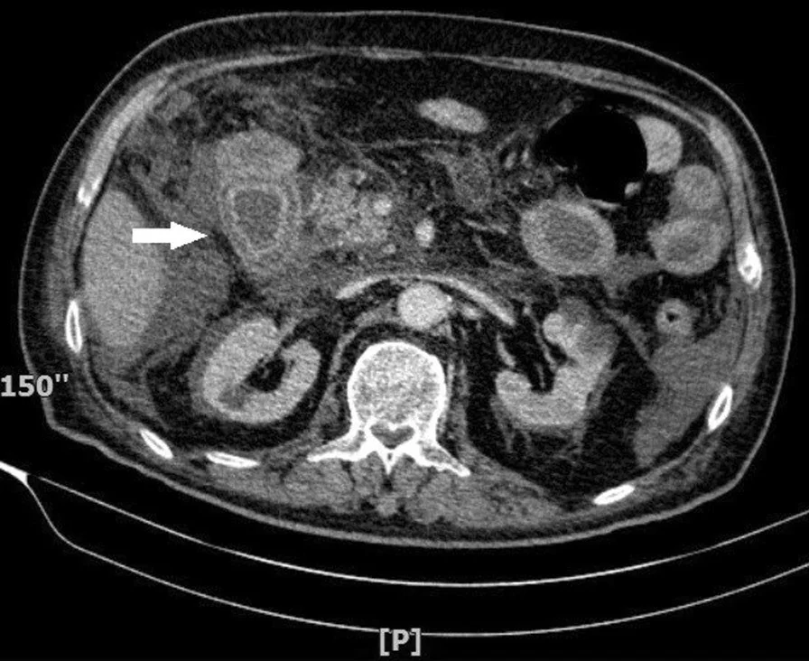 Duodenal iskemi ve infarkt: yayımlanmış olgu görüntüsü, aksiyel kesit