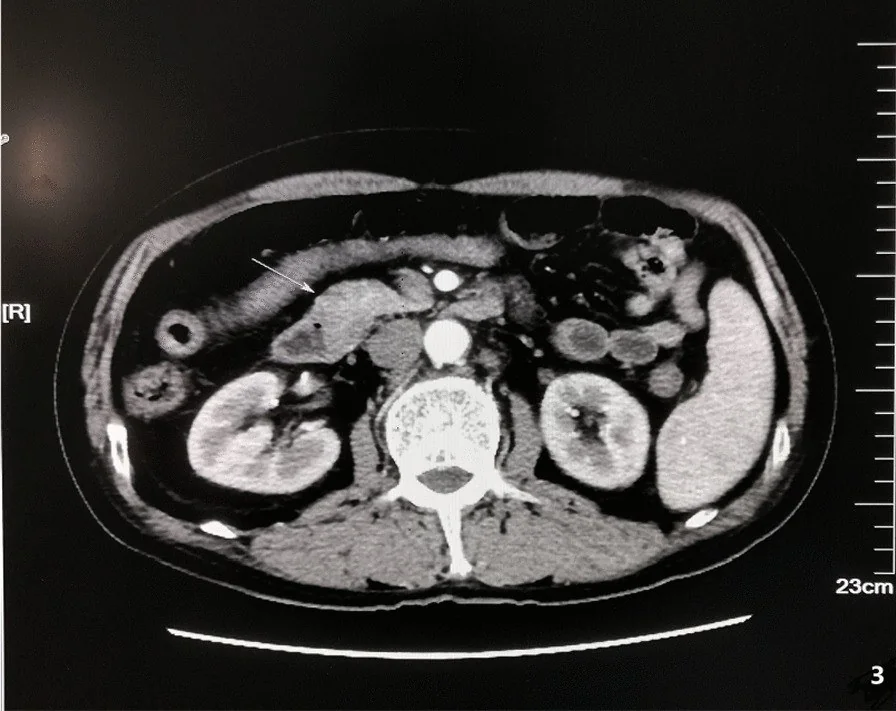 Duodenal lenfoma: yayımlanmış olgu görüntüsü, aksiyel kesit