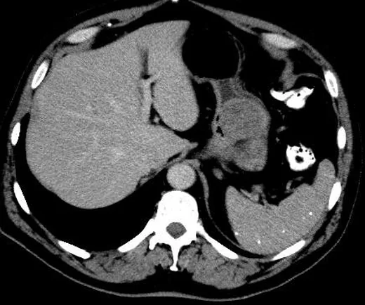 Gastrik gastrointestinal stromal tümör (GİST): yayımlanmış olgu görüntüsü, aksiyel kesit