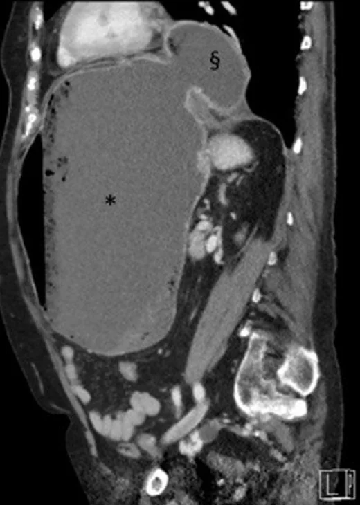 Mezenterikoaksiyel gastrik volvulus: yayımlanmış olgu görüntüsü, sagittal kesit