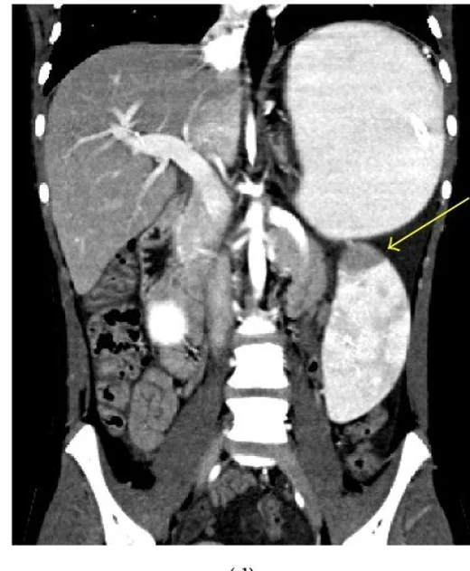 Organoaksiyel gastrik volvulus: yayımlanmış olgu görüntüsü, aksiyel kesit