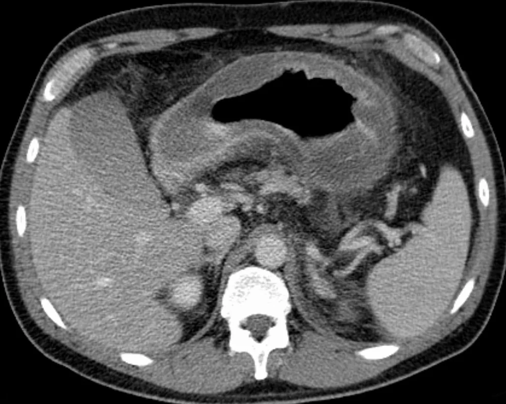 Gastrit ve gastroduodenit: yayımlanmış olgu görüntüsü, aksiyel kesit
