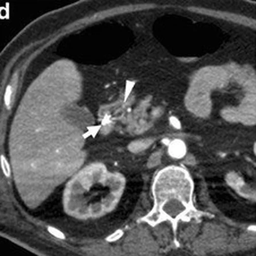 Gastroduodenal ülser kanaması: yayımlanmış olgu görüntüsü, aksiyel kesit