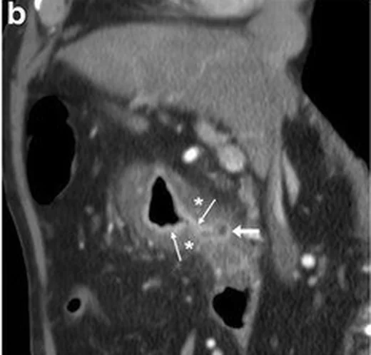 Mide ve duodenum peptik ülseri: yayımlanmış olgu görüntüsü, koronal kesit
