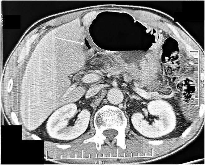 Gastrojejunostomi marjinal ülseri: yayımlanmış olgu görüntüsü, aksiyel kesit