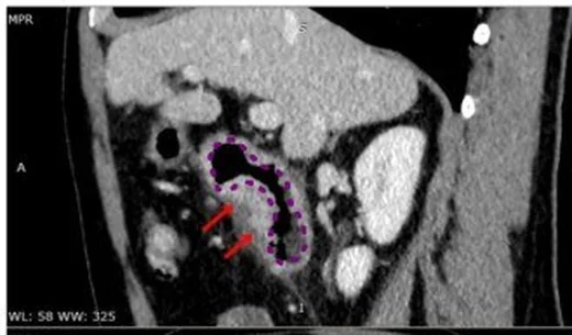 Groove (paraduodenal) pankreatit: yayımlanmış olgu görüntüsü, çok düzlemli kesit