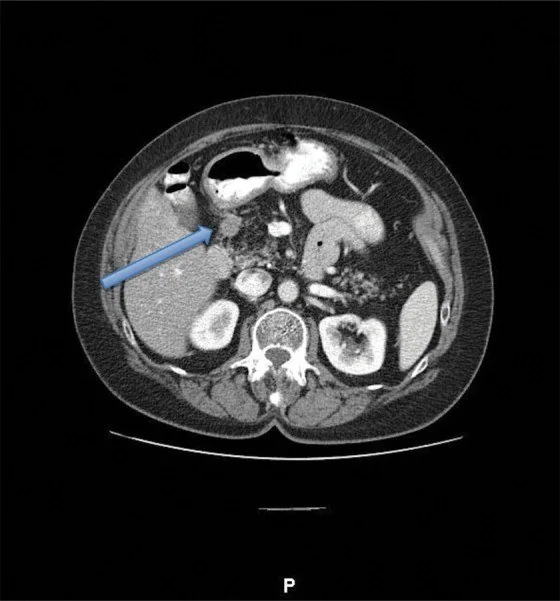 Pankreatikoduodenal oluk nöroendokrin tümörü: yayımlanmış olgu görüntüsü, aksiyel kesit